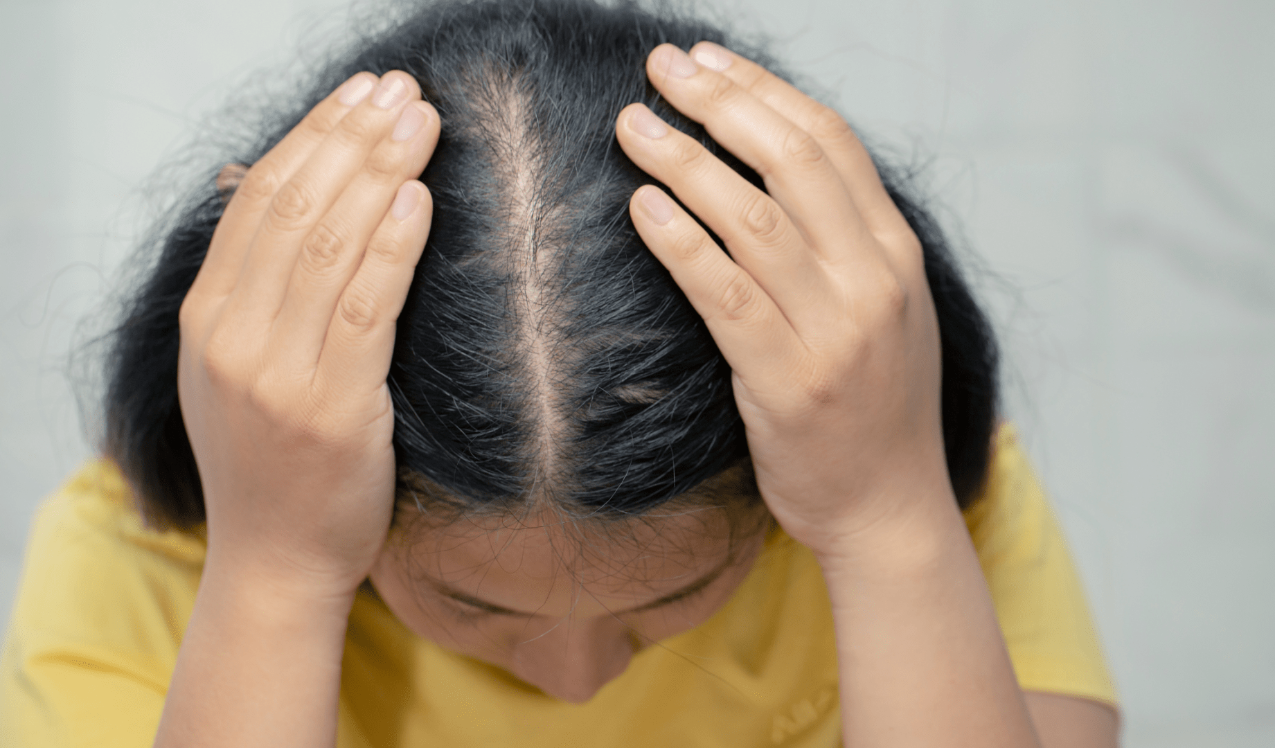 Hair Loss and PCOS Expert Insights and Treatment Options Invigor Medical