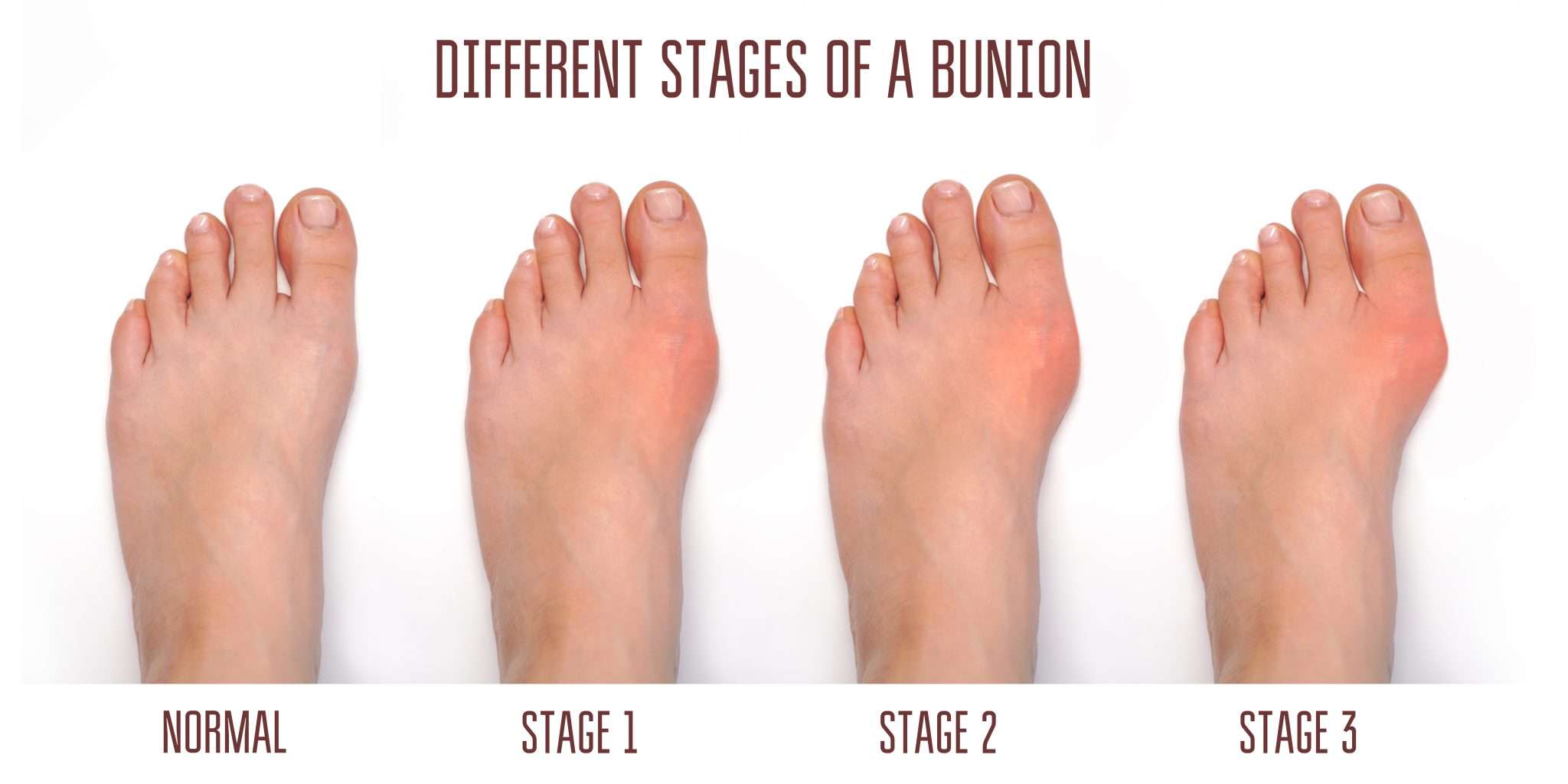 How To Heal A Sprained Toe Diagnosis And Treatment Invigor Medical